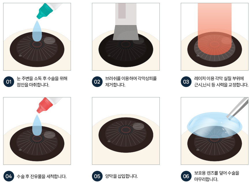 양막라섹의 적용방법