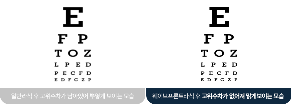 바른안과 웨이브프론트 시스템