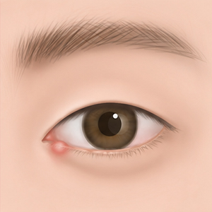 다래끼