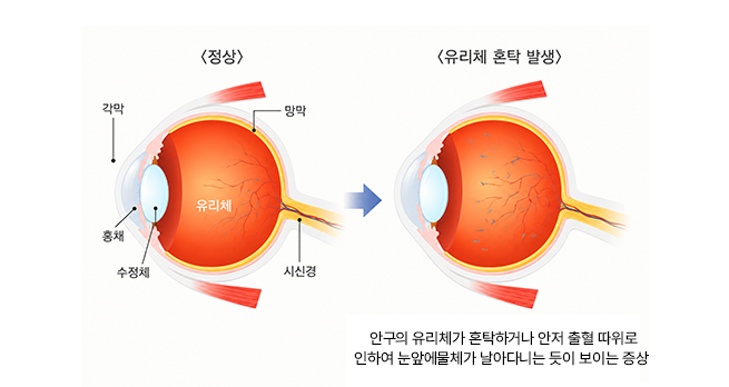 비문증 이미지