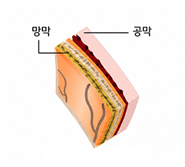 망막박리 정상