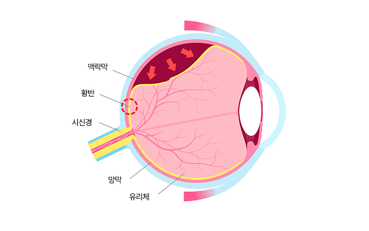 바른안과 망막박리